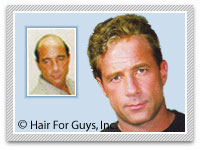 hair replacement system hairpiece