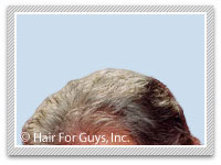 hair replacement system hairpiece